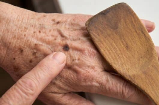 Receita caseira para acabar com manchas de idade da pele