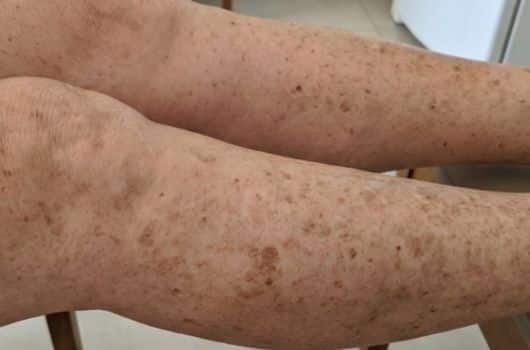 receita caseira para manchas na perna