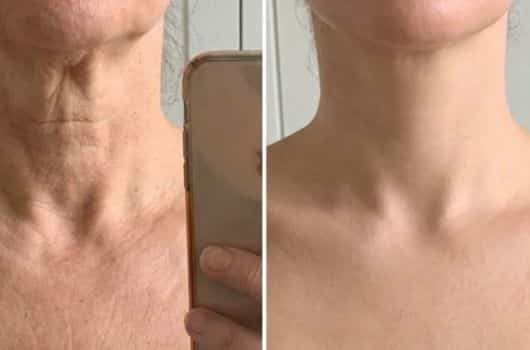 receita caseira para acabar com rugas