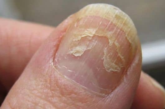 receita caseira para unhas quebradiças